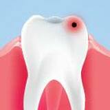 What are Dental Caries? Treatments, Signs, and Symptoms