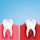 Types of Gum Disease: Stages, Factors & Related Conditions