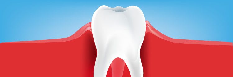 What is Gingivitis? Symptoms, Causes, and Treatments