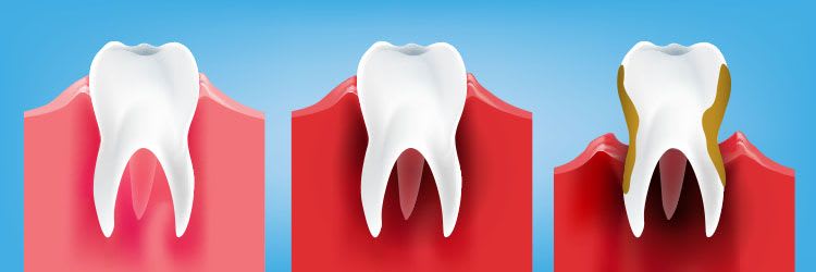 Types of Gum Disease: Stages, Factors & Related Conditions