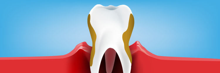 What is Periodontitis? Treatments, Signs, and Symptoms