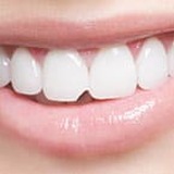 Chipped Tooth Repair with Chipped Tooth Bonding