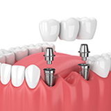 Dental Implants: What to Expect