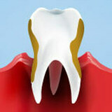 Gum Disease: Causes and Treatments
