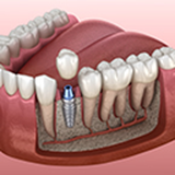 Dental Implants and Gum Disease: What You Need to Know